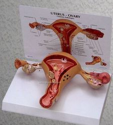 Diseased uterus  Model