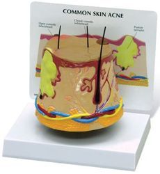Skin Acne Model