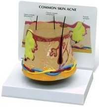 Skin Acne Model