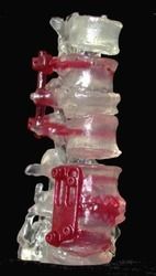 Red Lumbar Spine With Hardware