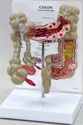 Colon Model With Pathologies