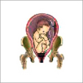 Complete Breech Presentation
