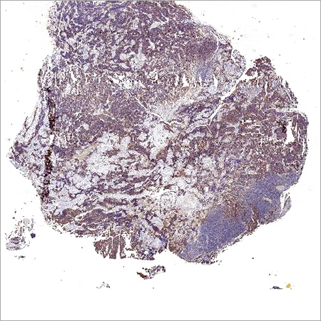 Immunohistochemistry Metastatic Lymph