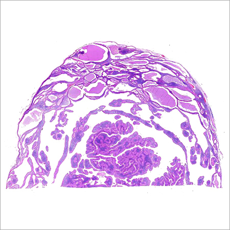 Warthins Tumor Glass Slide