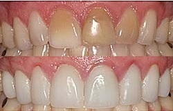 Tooth Discoloration Treatment