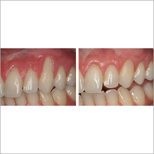 Gum Disease Treatment Services