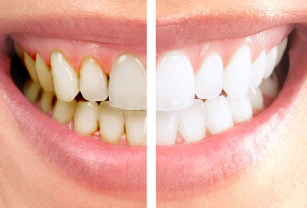 Teeth Polishing Services