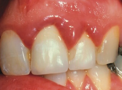 Periodontal Disease Treatment Services