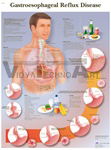 Reflux Disease - Anatomical Chart 