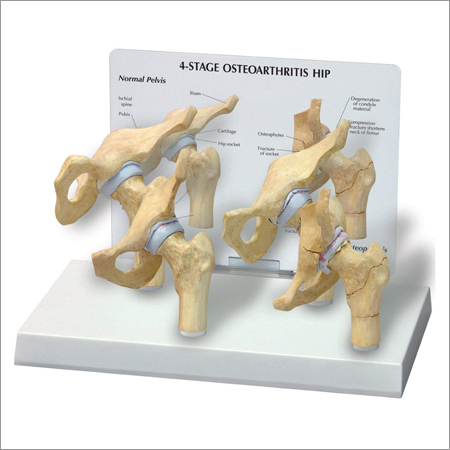 Hip Joint Osteoarthiritis 4 Stage