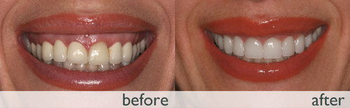 Gummy Smile Treatment Services