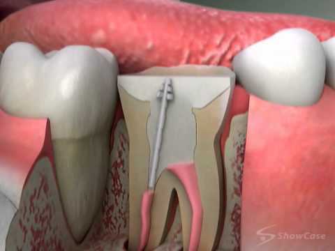 Teeth Core Treatment Services