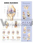 Knee Injuries Anatomical Chart