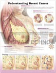 Understanding Breast Cancer Anatomical Chart, 2nd Edition - Paper, 20" x 26", Pink, Easy-to-Understand Visual Aid