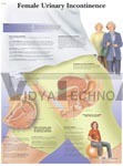 Female Urinary Incontinence - Anatomical Chart, Paper 20x26 Inches Beige, Detailed Anatomy Illustrations