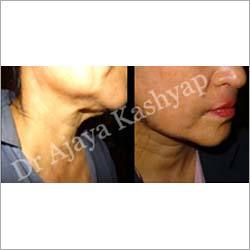 Neck Lift Surgery