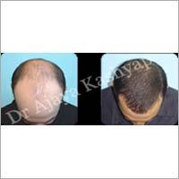 Hair Transplant Surgery