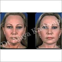 Forehead Lift Surgery