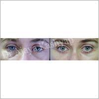 Face Surgery