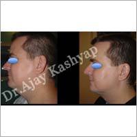 Vaser Liposuction