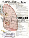 Understanding Lung Cancer Anatomical Chart - Paper, 20" x 26", Pink | Detailed Anatomy, Cancer Types, Diagnosis, Risk Factors, Treatment, Prevention