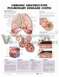 Chronic Obstructive Pulmonary Disease (COPD) Anatomical Chart, 1st Edition 