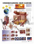 Understanding Skin Cancer Anatomical Chart - Laminated Paper, 20" x 26", Beige, Glossy Finish