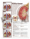 Understanding Kidney Cancer Anatomical Chart 