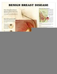 Benign Breast Disease Anatomical Chart