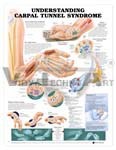 Understanding Carpal Tunnel Syndrome Anatomical Chart - Paper 20" x 26", Gloss Finish, White | Detailed Anatomy, Symptoms, Causes, Management