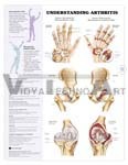 Understanding Arthritis Anatomical Chart 