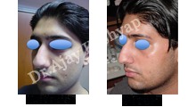 Surgical Dermabrasion