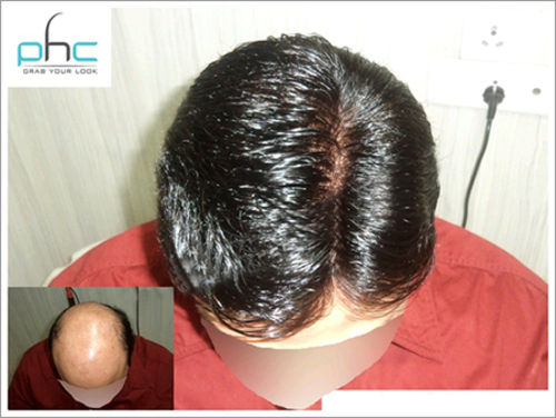 Non Surgical Hair Replacement Services