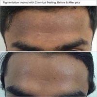 Chemical Peel - Advanced Chemical Treatment For Photo-ageing, Pigmentation, Fine Lines And Wrinkles | Stimulates Collagen Production, Improves Skin Texture, Repeat Applications Available