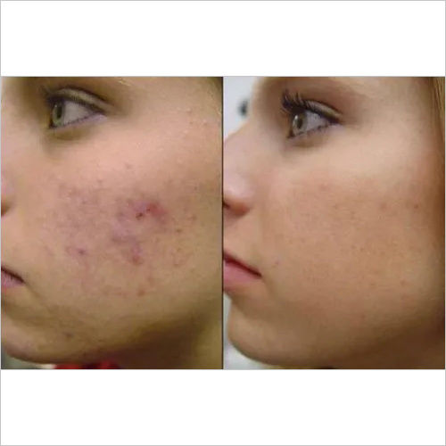 Acne Treatment Services