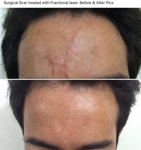 Scars Laser Treatment Services