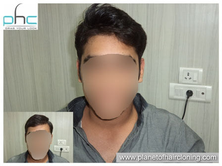 Best Hair Transplant in Noidahair transplant cost in noida by GUNJAN  CLINICS on Dribbble