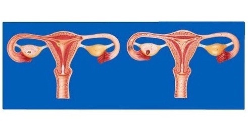 Gynecological Models