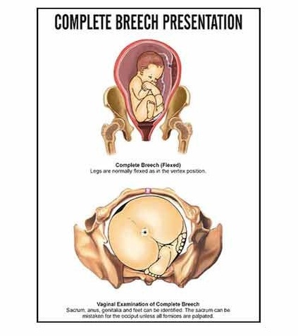 INC06 - Complete Breech Presentation