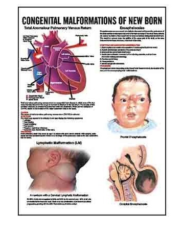 INC15 - Congenital Malformation Of New Born