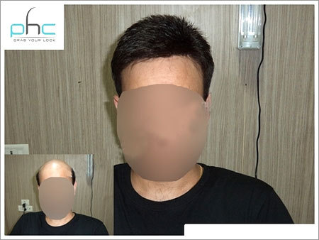 Hair Fixing Services in Malviya Nagar, New Delhi - Phc- The Planet Of Hair  Cloning