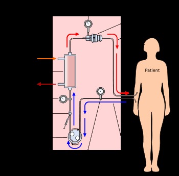 Hemodialysis System