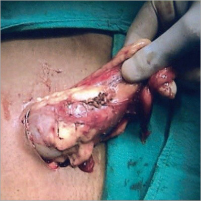 Laparoscopic Nephrectomy