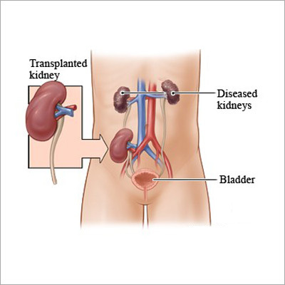 Kidney Transplant