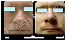Rhinoplasty-Nose Surgery