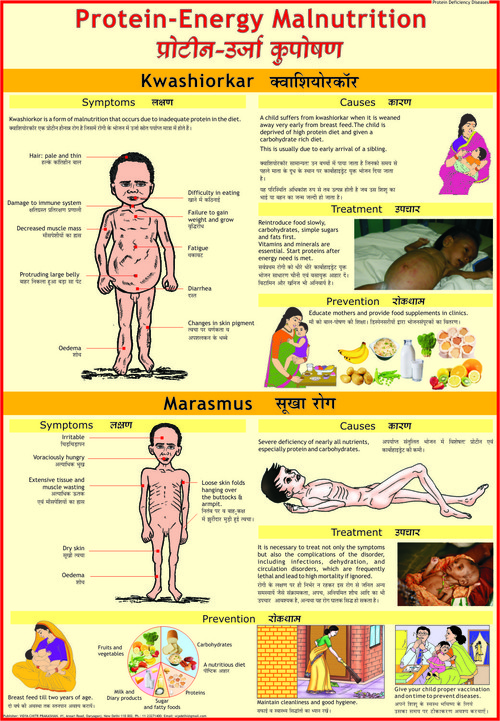 Protein Energy Malnutrition (Kwashiorkar & Marasmus) Chart
