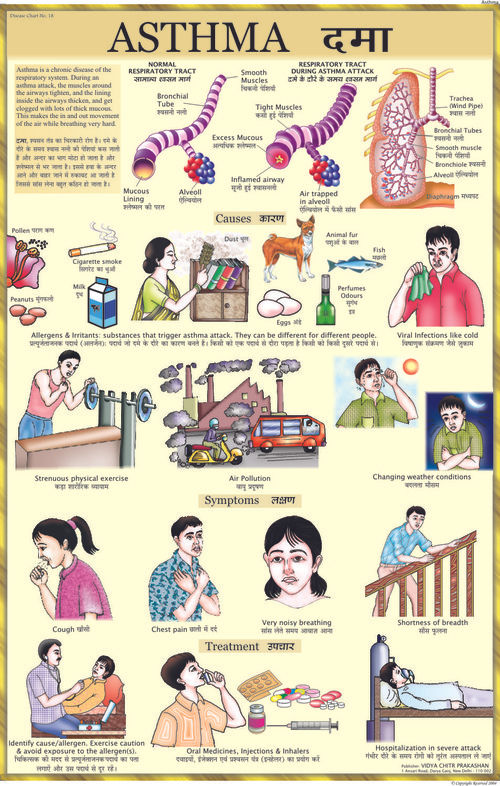 Asthma Chart Dimensions: 70 X 100 Centimeter (Cm)