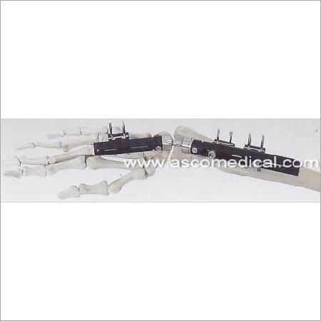 Distal Radius Fragment External Fixator - Titanium Alloy, Variable Dimensions | Stable Fixation, Precise Adjustment, Minimally Invasive, Early Mobilization