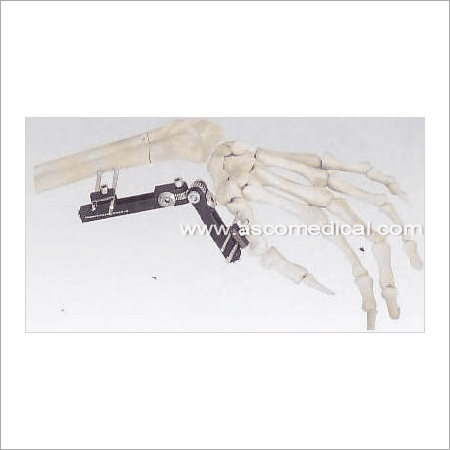 Distal Radius Fragment External Fixator