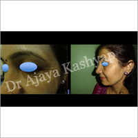 Botox Cosmetic Treatment